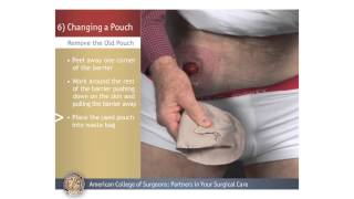 ColostomyIleostomy Changing a Pouch [upl. by Yecram]