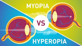 Difference between Myopia Near Sightedness amp Hyperopia FarSightedness [upl. by Oedama699]