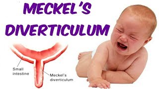 Meckels Diverticulum [upl. by Florie]